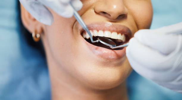 Best Emergency Dentist for Lost Fillings or Crowns in Morganton, NC